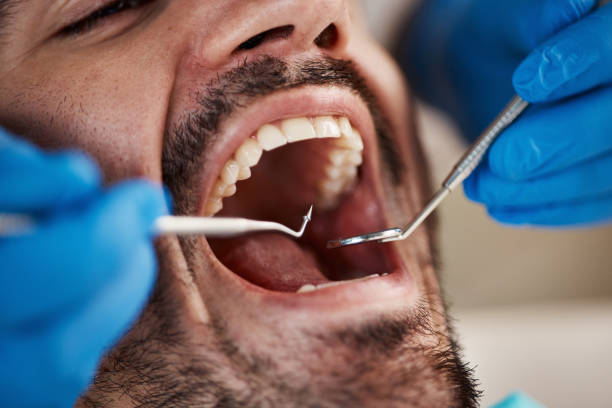 Best Emergency Dentist for Knocked-Out Tooth in Exeter, CA